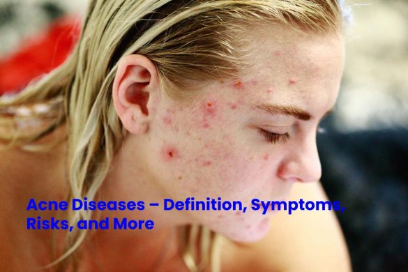 Acne Diseases – Definition, Symptoms, Risks, and More