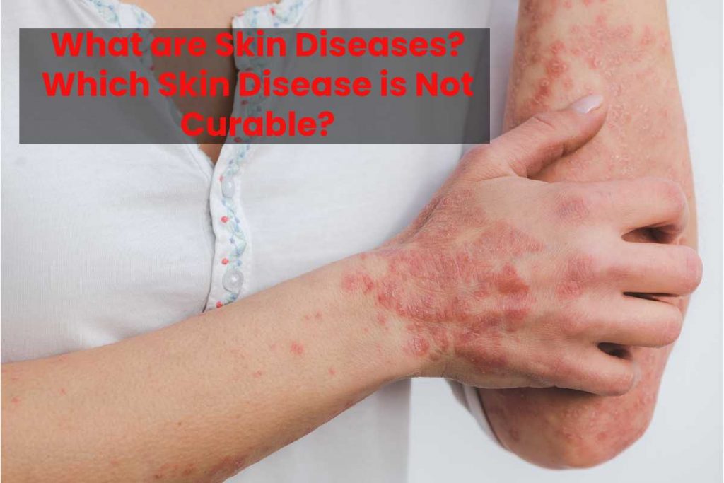 What are Skin Diseases? Which Skin Disease is Not Curable?