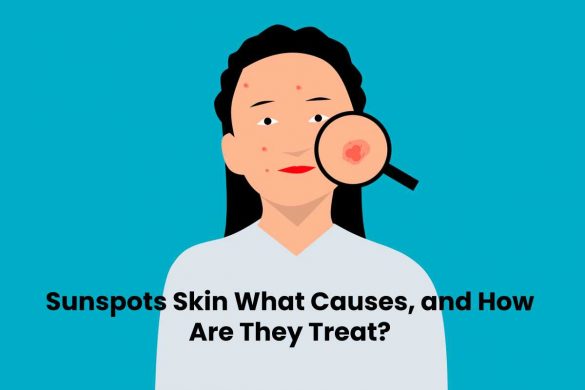 Sunspots Skin What Causes, and How Are They Treat?