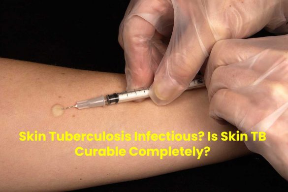 Skin Tuberculosis Infectious? Is Skin TB Curable Completely?
