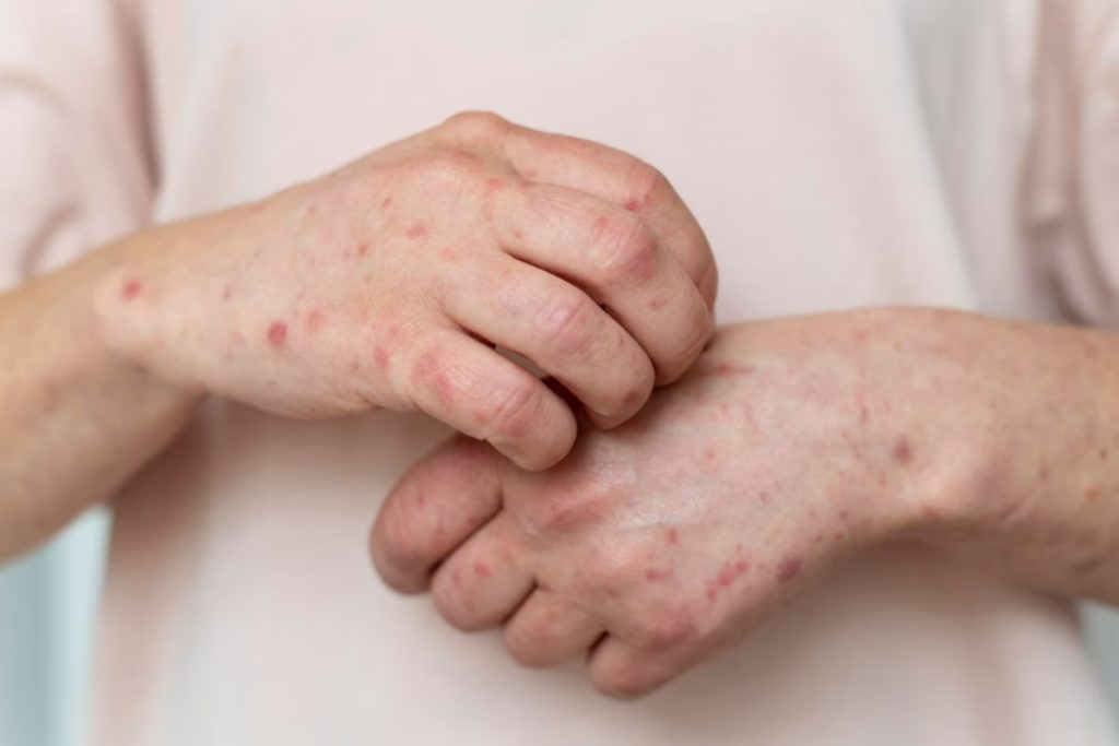 Skin Infection Reasons - Write for US