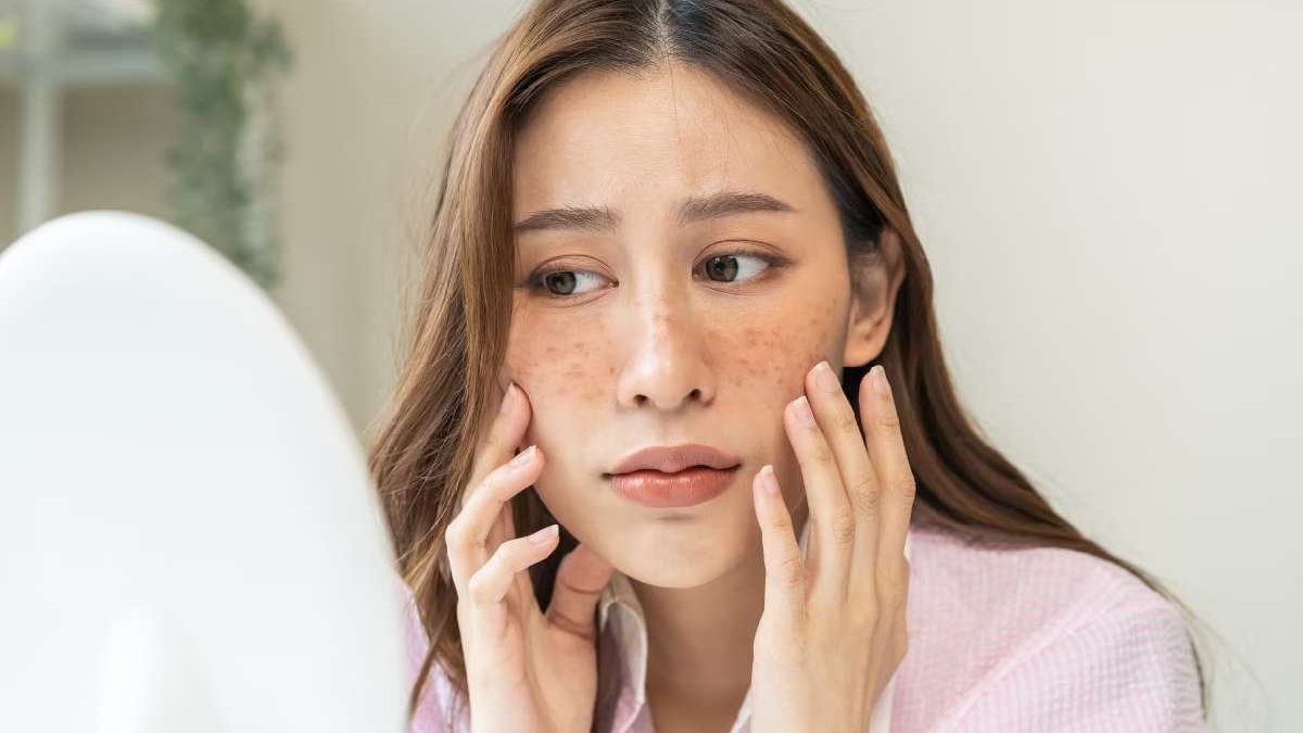 Sunspots – Sunspots Skin, Causes, Treatment, and More