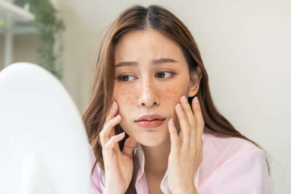 Sunspots - Sunspots Skin, Causes, Treatment, and More