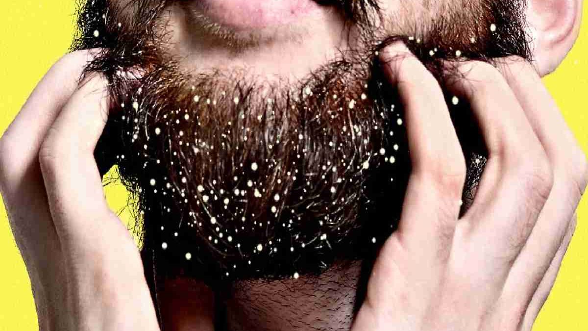 Beard Dandruff – Introduction, Causes, Types, Solution