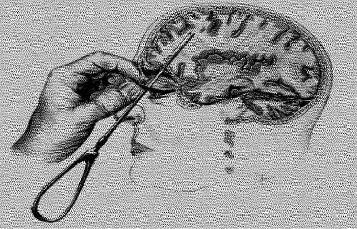 The Origins of Lobotomy